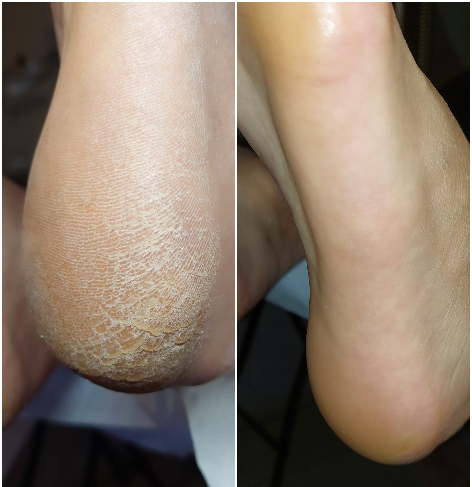 Přístrojová pedikúra - práce s přístrojem na noze Bohumín